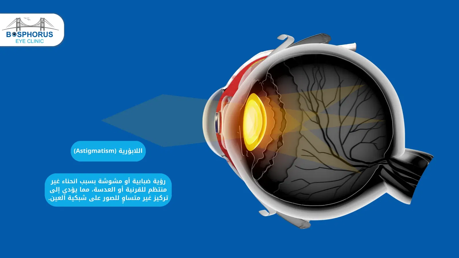 اللابؤرية (Astigmatism)