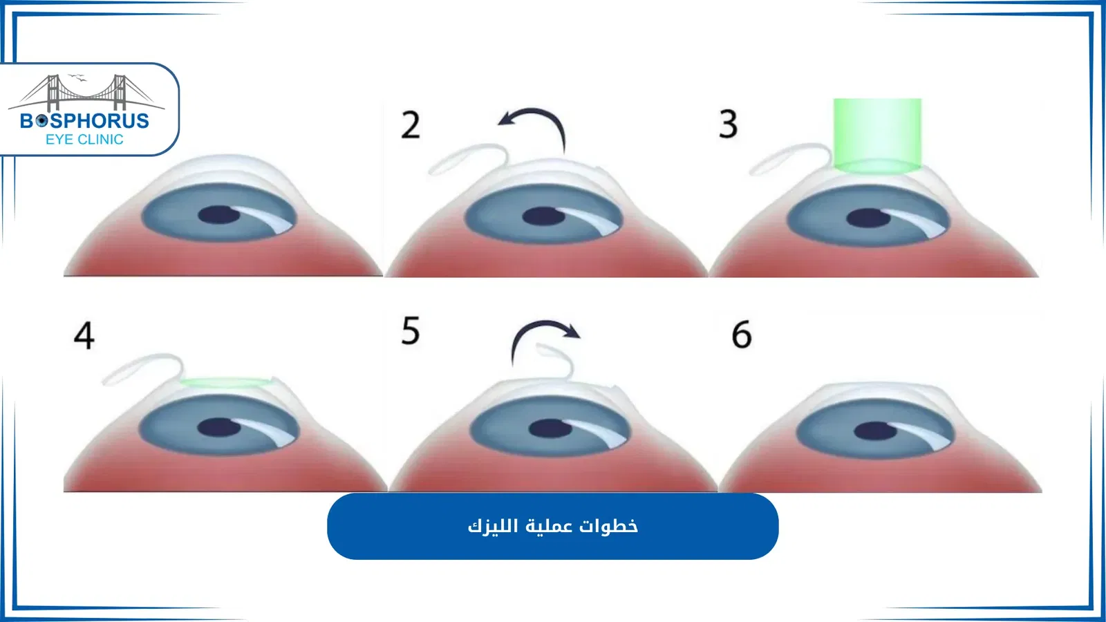 طريقة عمل الفيمتو ليزك