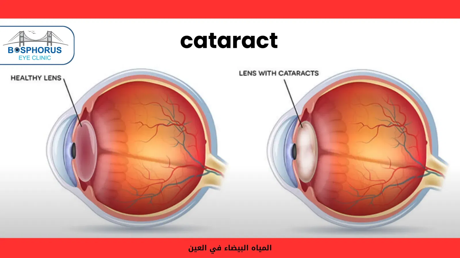 ماهي اعراض الماء الابيض في العين